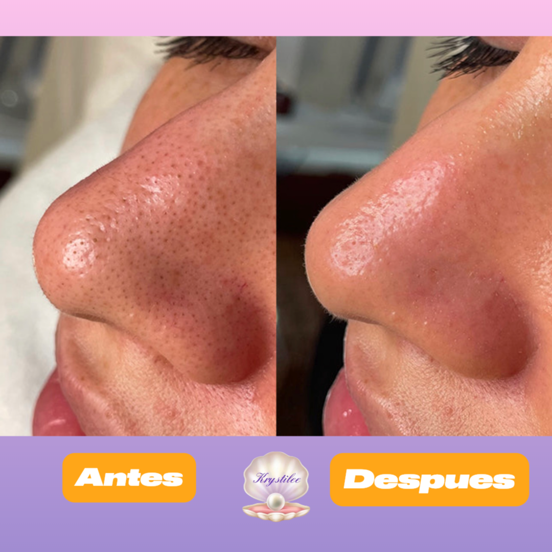 Kit Profesional Completo de Microdermoabrasión con Puntas de Diamante